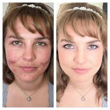 Before And After Dinair Airbrush Makeup Www Airbrushmakeup Com Rosacea Makeup Younique Makeup Best Makeup For Rosacea