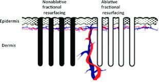 نتیجه جستجوی لغت [ablative] در گوگل