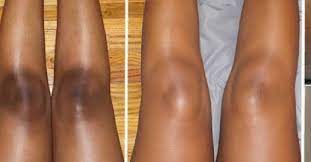 Today we are going to talk about how to lighten dark knees and elbows fast and naturally! Scooper 010 News 3 Easy Ways To Lighten Dark Patches On The Knees