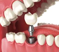 Watson dental care explains the reasons for extracting a tooth, and what orlando residents can expect if they need a tooth removed. Dental Implants In Kissimmee Fl Dental Implants Near You