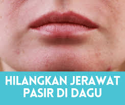Cara menghilangkan jerawat bruntusan di jidat ini dapat anda lakukan secara rutin, dan hindari memencet bruntusan tersebut agar cepat hilang. Cara Menghilangkan Jerawat Pasir Di Dahi Dagu Pipi Sihat Me