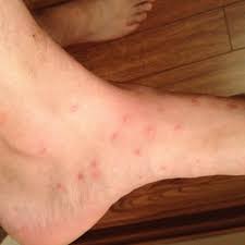 Image result for bedbug bites look like