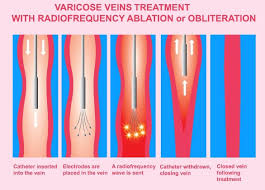Image result for Radiofrequency Surgery