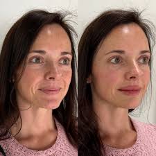 Hannah Kinard, RN BSN ✨ Aesthetic Nurse (@aestheticskin_rn) • Instagram  photos and videos