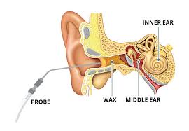 Ear wax can protect your ear, it can become damaging when there is excessive of it. Ear Wax Removal Sharmans Pharmacy