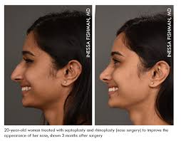 Rhinoplasty Or Nose Surgery Is One Of Our Most Favorite Procedures Both For Its Exacting Demands And Artis Plastic Surgery Rhinoplasty Rhinoplasty Nose Jobs