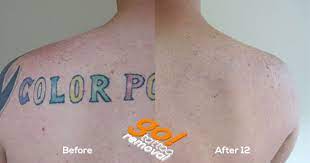 In addition, tattoos that are green, blue, or yellow take more time to remove than tattoos that are black or red. How Long Does It Take To Remove A Tattoo Go Tattoo Removal Allentown Pennsylvania