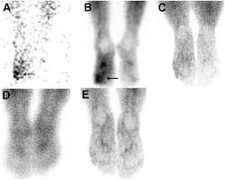 Image result for Osteomyelitis Bone Scan