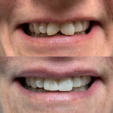 What do i do if i have an interproximal cavity? Front Teeth Fillings Before And After Cumming Dental Cumming Ga