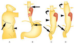 Minimally invasive mckeown esophagectomy (mie mckeown) with cervical anastomosis is a widely used approach for the treatment of esophageal cancer (ec). Postoperative Imaging Of Esophageal Cancer What Chest Radiologists Need To Know Radiographics