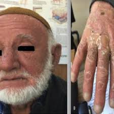 Severe erythema of the face (a), desquamative and erosive erythema on...