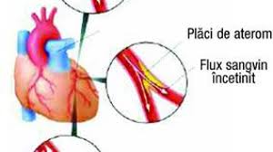 We did not find results for: Simptomele Unui Infarct Cum SÄƒ RecunoÈ™ti ApariÈ›ia Infarctului Miocardic