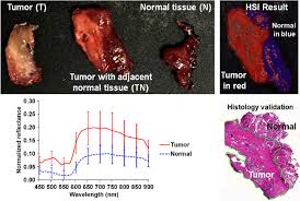 Positive margins, on the other hand, may indicate the presence of invasive breast cancer, and you may need to have a mastectomy in order to be sure that all cancer has been removed and to prevent a recurrence. Tumor Margin Detection Of Surgical Specimens From An H N Cancer Download Scientific Diagram