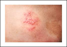 Image result for Varicella zoster on human skin