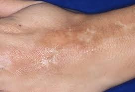 Lupus (systemic lupus erythematosus) causes symptoms like joint pain, tiredness and skin rashes. Versteckte Hinweise Auf Der Haut Bildergalerie Zu Rheumatischen Erkrankungen
