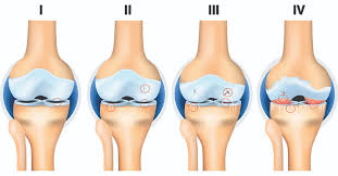 Durerea de rinichi este resimțită fie la nivelul flancurilor (în regiunile laterale ale abdomenului), fie în lojele renale (posterior, sub grilajul costal, lateral de coloana vertebrală), de unde poate iradia spre abdomen, perineu sau fosele iliace. Durerile De Spate Pot Semnala ExistenÅ£a Unor Probleme Grave De SÄƒnÄƒtate ArticulaÈ›ii Pe Picioare È™i Dureri La Rinichi