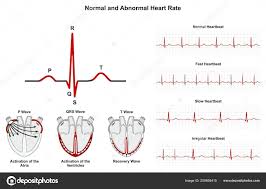Normal Abnormal Heart Rate Infographic Diagram Including