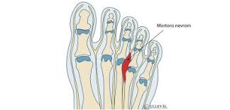 Jeg ble helt nummen i kroppen og klarte ikke løpe. Mortons Nevrom Den Store 2020 Guiden Ulleval Kiropraktorklinikk