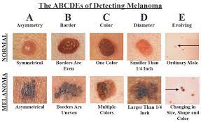 Checking your skin for suspicious changes can help. 10 Skin Cancer Signs You Should Never Ignore Live Love Fruit