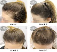 Female Pattern Hair Loss Nhs In 2020 Female Pattern Hair Loss Hair Loss Natural Remedy Female Pattern Baldness