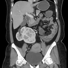 Crossed Fused Renal Ectopia Essentially Refers To An Anomaly Where The Kidneys Are Fused And Located On The Same Side Of The Midl Renal Renal Disease Radiology