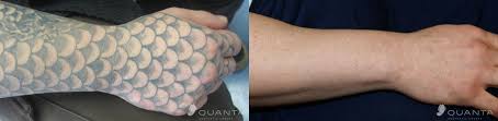 Tattoo removal of unwanted tattoos. 15 Trendy What Does A Laser Removed Tattoo Look Like