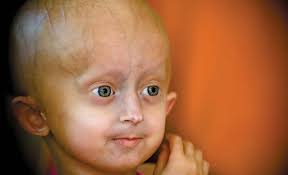 Omim #176670) is a very rare genetic disease, characterized by precocious ageing in early infancy. Progeria Definition Types Symptoms Facts Britannica