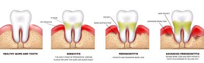 Left untreated, gingivitis can turn into periodontal disease (see signs of gum disease). Gum Inflammation Gingivitis Periodontitis Artedental