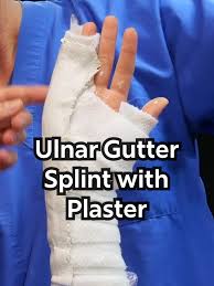 Image result for Ulnar Gutter Splint