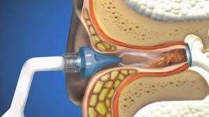 Otoclear Ear Irrigation Youtube