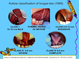 Image result for Ankyloglossia