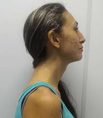 UNILEÃO CENTRO UNIVERSITÁRIO CURSO DE BACHARELADO EM FISIOTERAPIA RONISE  ALVES FEITOSA GRANGEIRO ABORDAGEM CINESIOTERAPÊUTIC