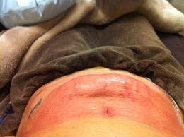 How much does coolsculpting cost for stomach? Smart Liposuction Vs Coolsculpting 35 Times More Fat For Less