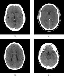 Image result for CT Head