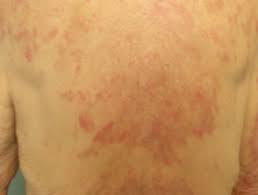 Mehr über symptome, ursachen und therapie von wundrose. Arzneimittelinduzierter Lupus Erythematodes Dermatly Com Ihre Hautstelle
