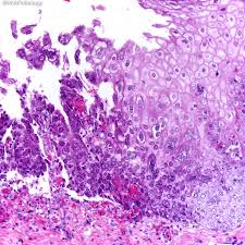 Esophagitis is an inflammation of the lining of the esophagus, the tube that carries food from the throat to the stomach. Webpathology Com A Collection Of Surgical Pathology Images