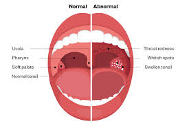 Case Based Learning Sore Throat Learning Article Pharmaceutical Journal