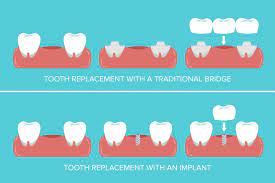 Thus, a bridge with only one pontic will cost less than a bridge with two or three pontics. How Much Does A Dental Bridge Costs In The Usa
