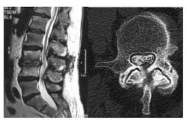 Degenerative Spondylolisthese Ursachen Diagnose Therapien Orthinform