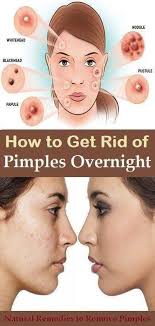 The Best Ways To Get Rid Of Pimples On Nose Fast And Overnight How To Get Rid Of Pimples On Nos How To Get Rid Of Pimples How To Remove