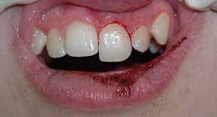 Faq Loose Tooth Discovery Pediatric Dentistry