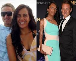 This Ex Model Australian Turia Pitt Suffered 65 Percent Burn Injury But Her Boy Friend Did Something Amazing Burn Injury Engagement Photos Fall Burn Survivor