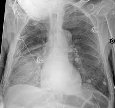 Airspace Diseases Radiology Key