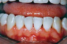 Search 123rf with an image instead of text. The Management Of Gingivitis Gponline