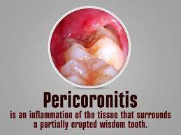 Pin On Oral Surgery