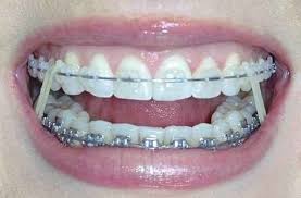 The 26 Stages Of Getting Braces Getting Braces Teeth Braces Dental Braces