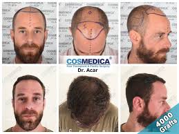 A cosa è dovuto questo fenomeno e quali sono i rischi quando si esce dall'europa? Trapianto Capelli Istanbul Clinica Cosmedica Dr Acar