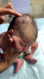 Image result for Cephalhematoma