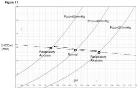 Respiratory Alkalosis Wikipedia