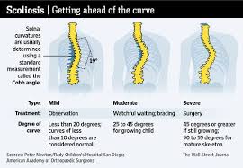 Getting Ahead Of The Curve On Scoliosis Scoliosis